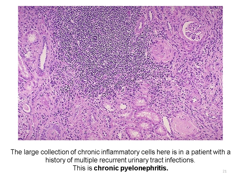 21 The large collection of chronic inflammatory cells here is in a patient with